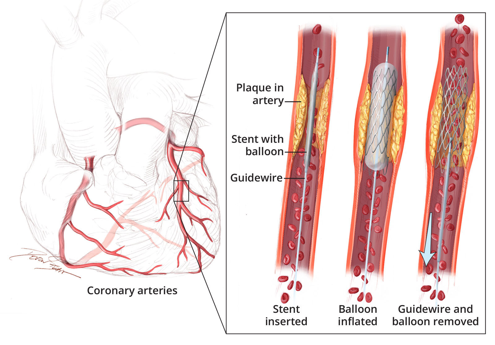 NHLBI illustration of the coronary arteries and three stages of stent placement: balloon-mounted stent delivered over a guidewire, balloon inflated to expand the stent, then balloon and guidewire removed with stent remaining
